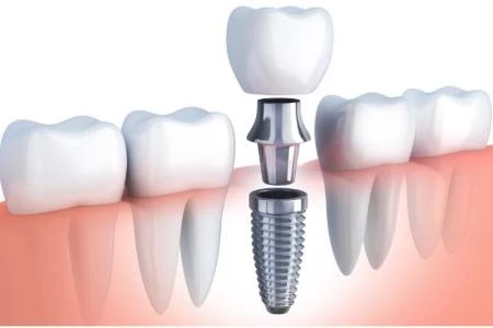 Sestava implantata