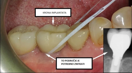  Krona implantata