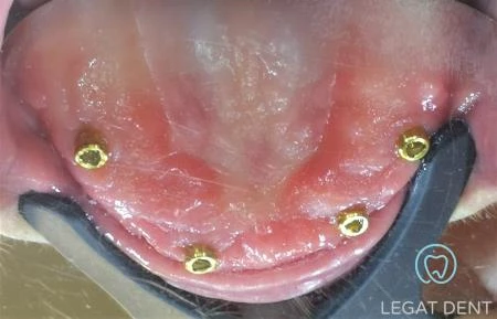 Stanje po implantaciji - brezzoba čeljust z vsadki