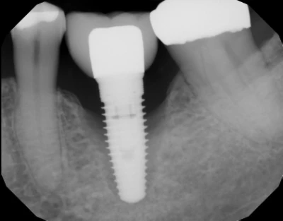 Neuspešna implantacija