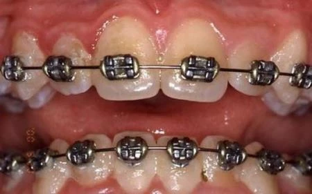 Breketi ortodonstkega aparata otežujejo dobro higieno
